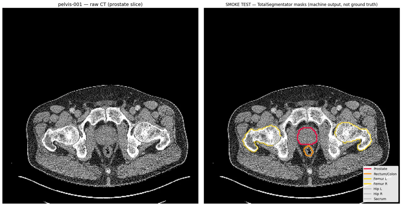 Raw pelvis CT vs. TotalSegmentator output — the soft-tissue region where thresholding has no edge to find