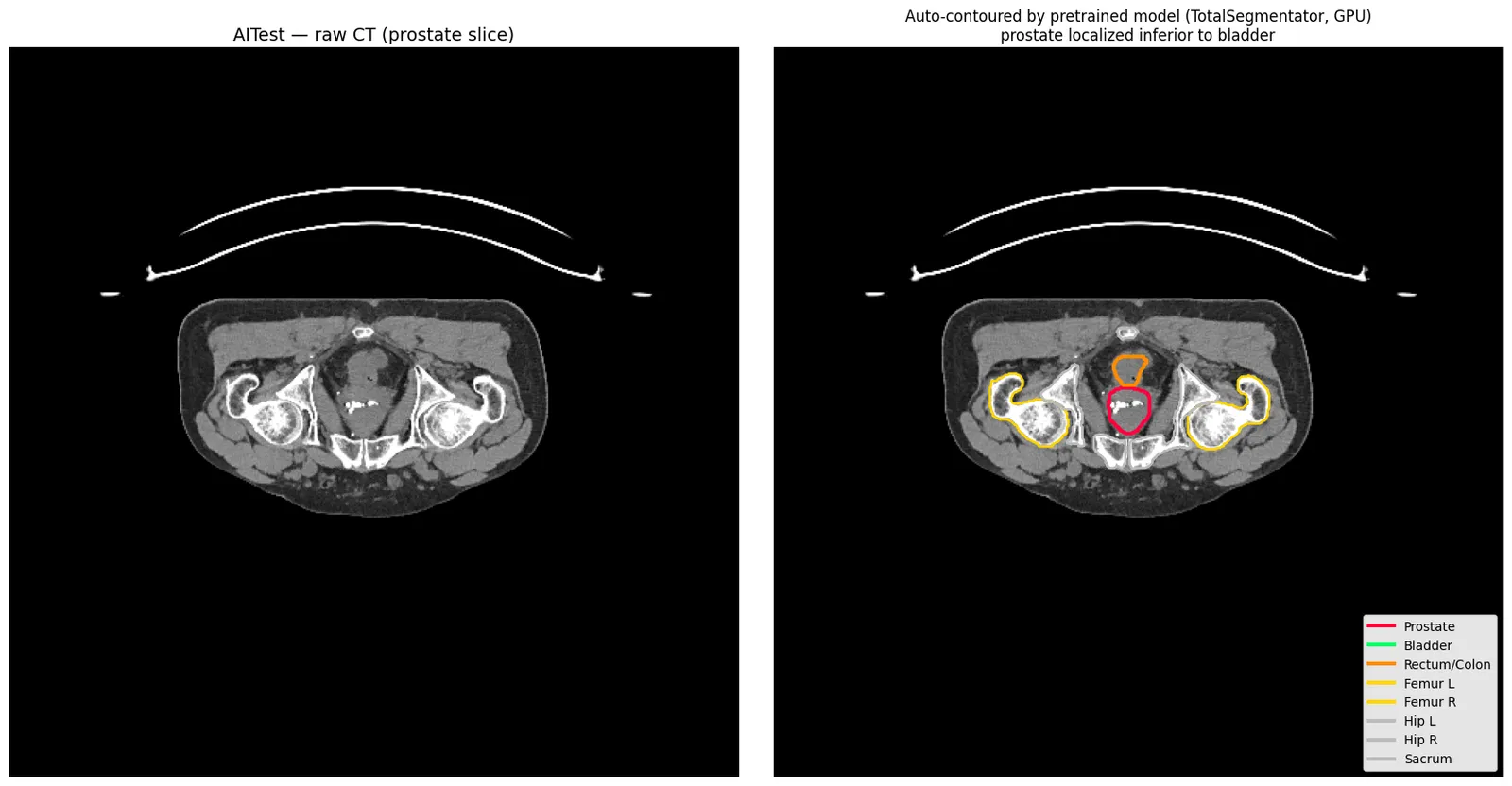 Prostate contoured on a real CT slice — learned shape priors where intensity fails